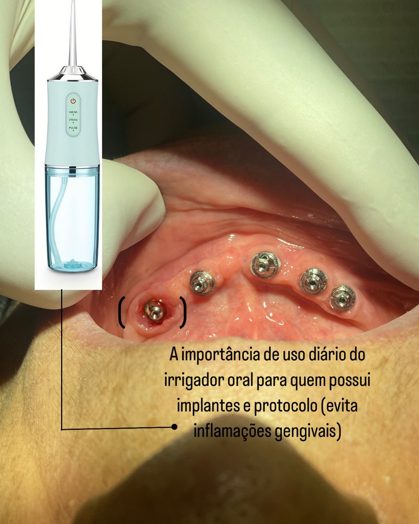 Reabilitação e Implantes